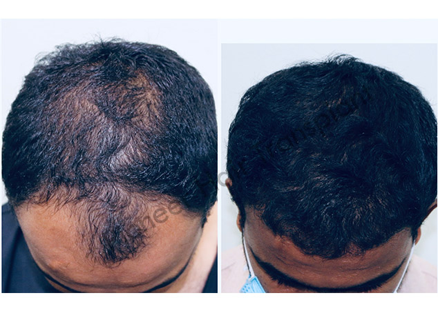 DHT Hair Transplant in Bangalore