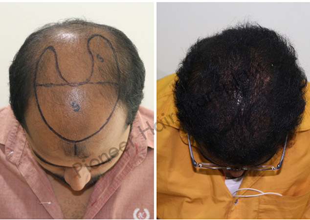 FUE Hair Transplant Cost in Bangalore