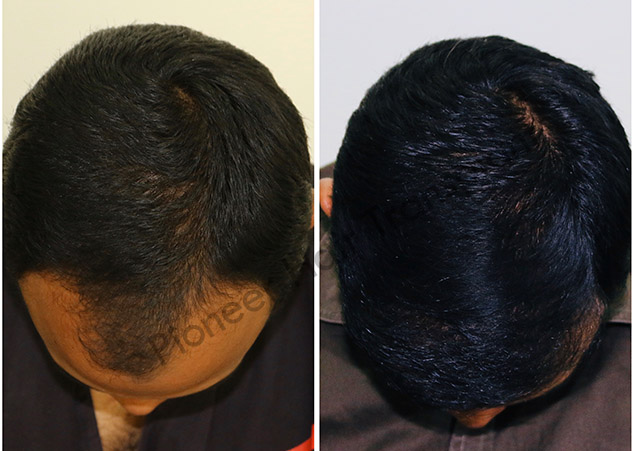 Micro FUE Hair Transplant in Bangalore
