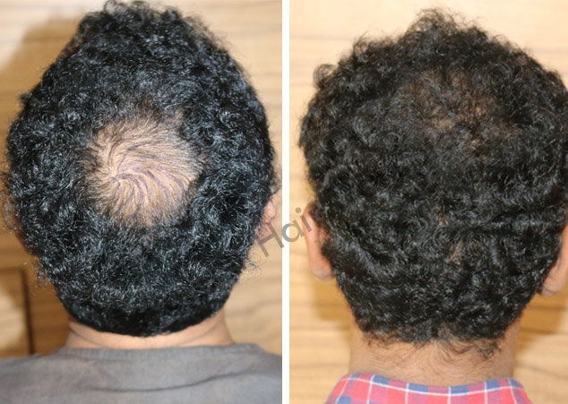 FUT Hair Transplant Cost in Bangalore