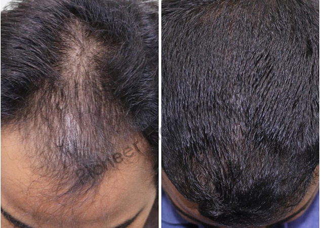 Gallery Pioneer Hair Transplant