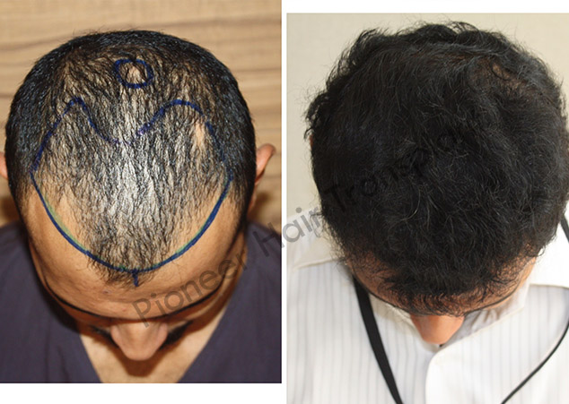 DHT Hair Transplant in Bangalore
