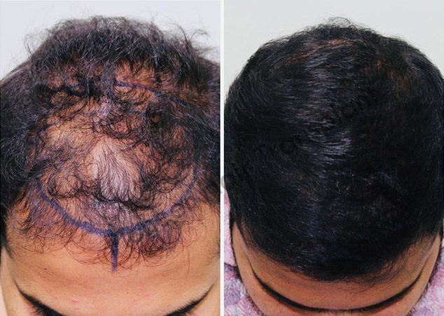 NeoGraft Hair Transplant Bangalore