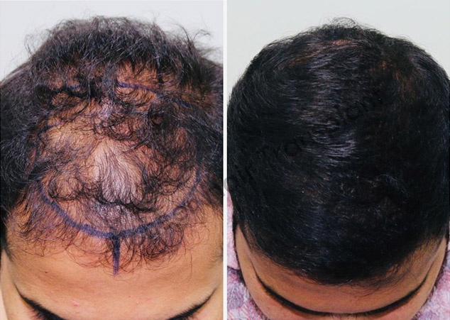 Gallery Pioneer Hair Transplant