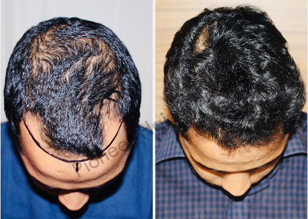 Gallery Pioneer Hair Transplant