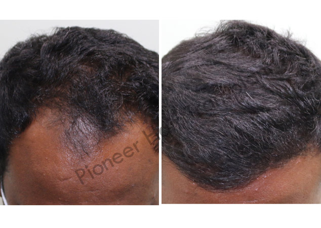 Gallery Pioneer Hair Transplant