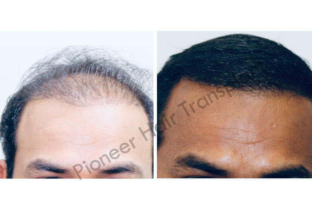 Gallery Pioneer Hair Transplant