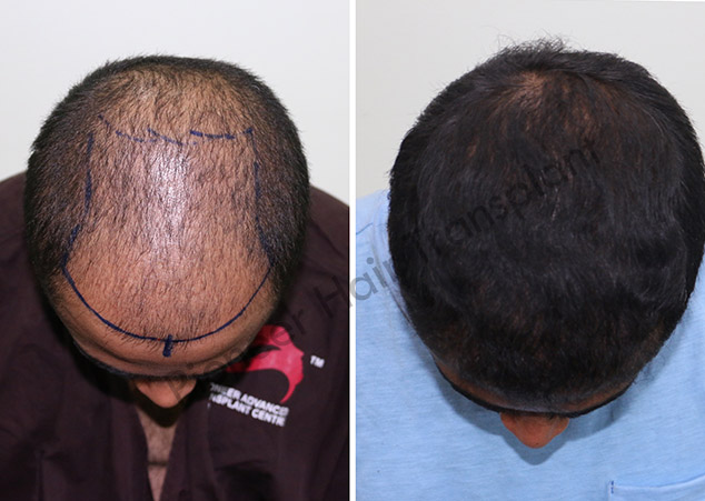 FUE Hair Transplant Cost in Bangalore