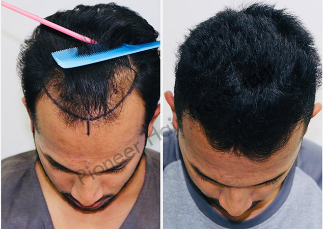 Repair Hair Transplant in Bangalore