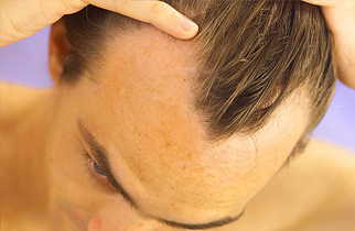 Bio PRP Hair Loss Treatment Bangalore