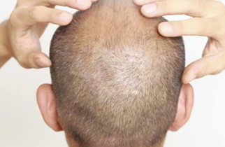 FUE Hair Transplant Bangalore