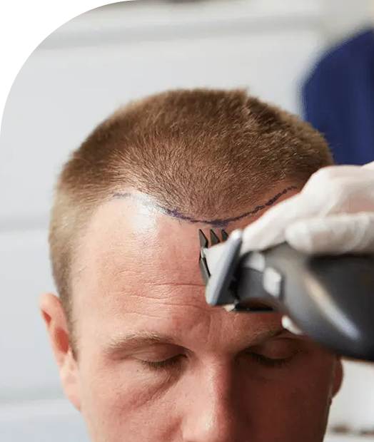 Hair Transplant Clinic Bangalore.